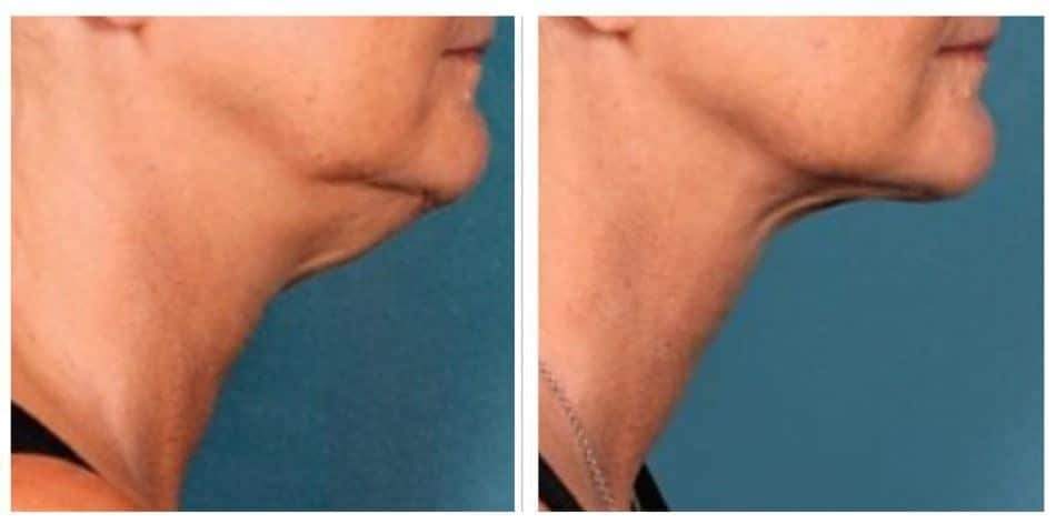 1 Kybella 2 1