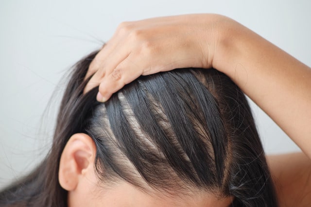 alopecia areata 2 2