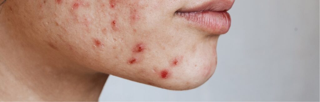 Acne Treatment 1.2x.jpg
