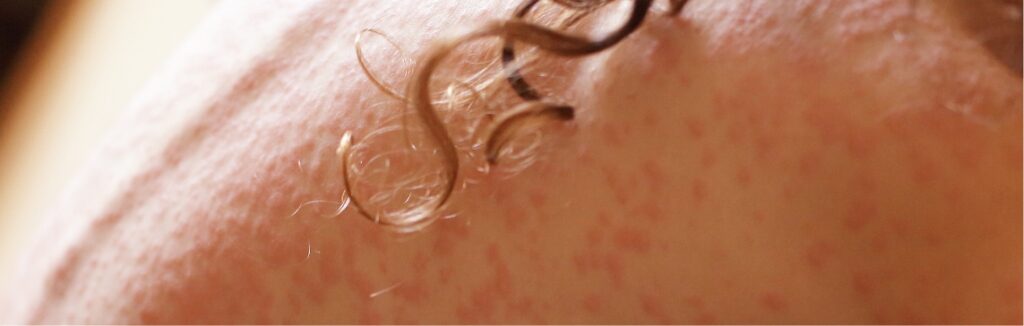 Psoriasis 1.2x.jpg