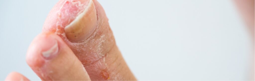 athlete’s foot 1.2x.jpg