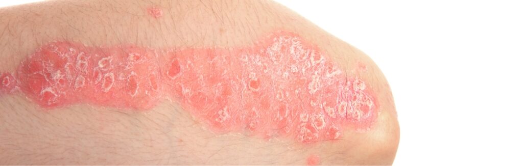 eczema 1.2x.jpg