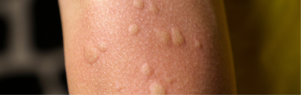glutathione peroxidase inhibitor endothelial cell dysfunction: molecular mechanisms and clinical implications QUANTITY:Single Unit Tritium - Diamond Skin Pelle mista