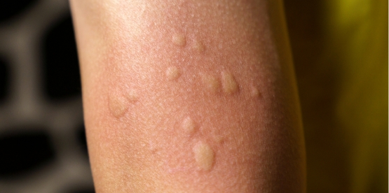 hives 1.2x.jpg hives 1.2x.jpg