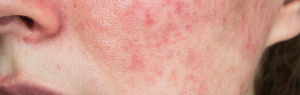 rosacea 1.2x.jpg