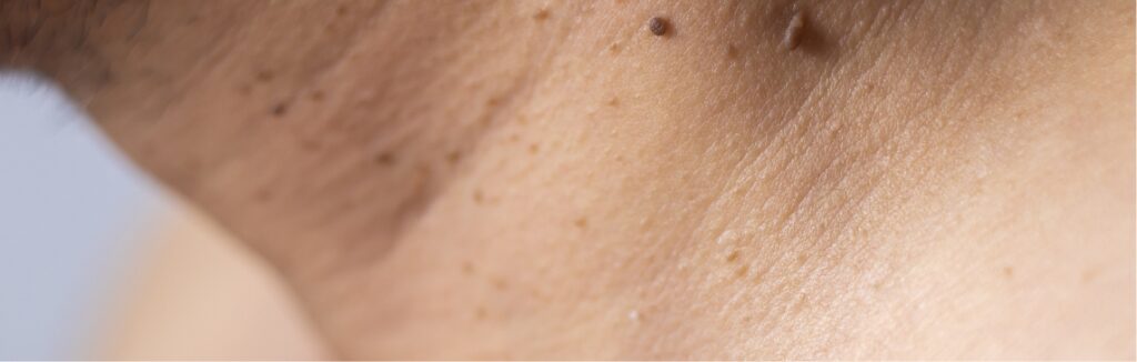 skin tags 1.2x.jpg