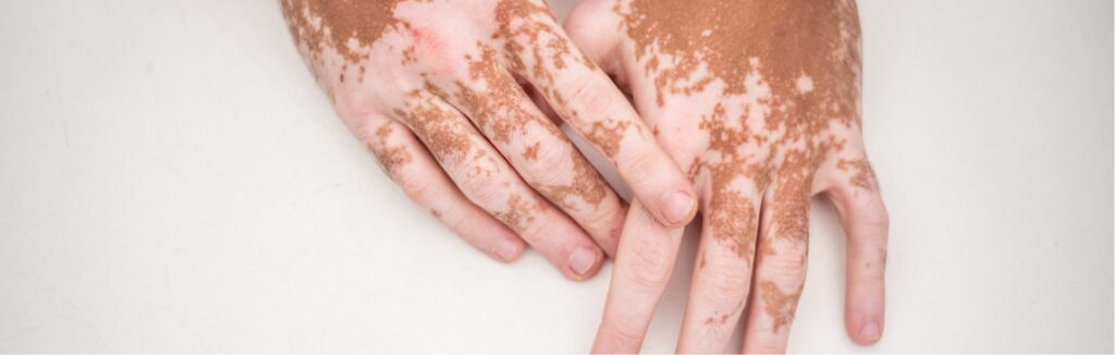 vitiligo 1.2x.jpg