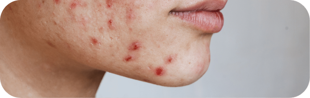 Acne Treatment