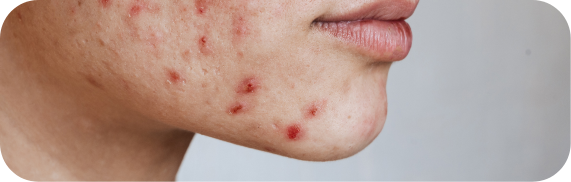 Red Light Therapy for Acne Scars: Effective Healing Secrets Revealed