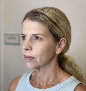 After Image: Chemical Peel