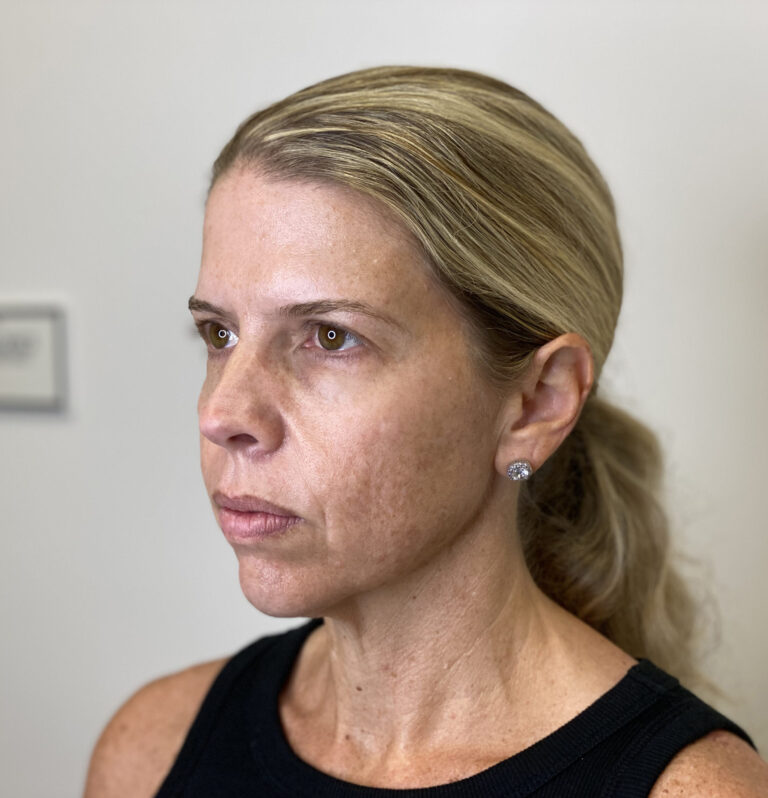 Before Image: Chemical Peel - left-front-oblique