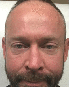 After Image: Botox – Men’s Forehead