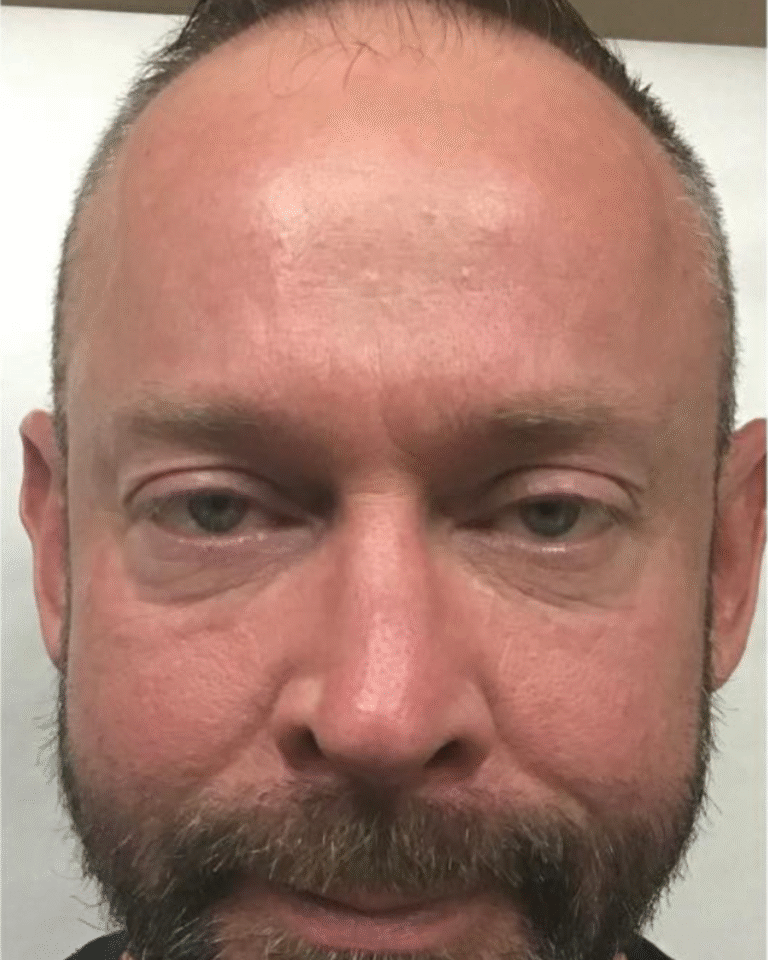 After Image: Botox – Men’s Forehead - front