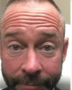 Before Image: Botox – Men’s Forehead