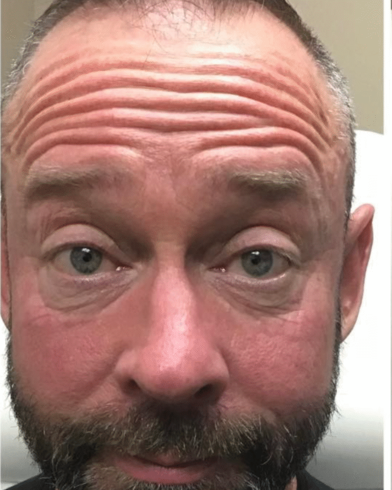 Before Image: Botox – Men’s Forehead - front