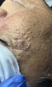Before Image: Extractions