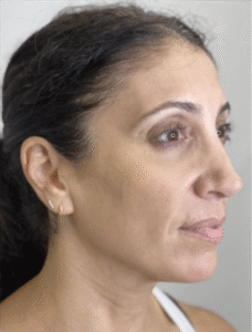 After Image: Microneedling