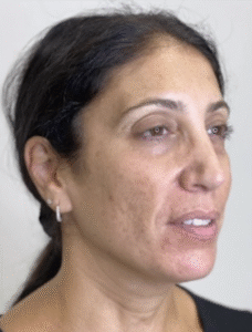 Before Image: Microneedling