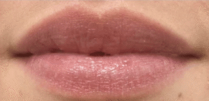 After Image: Restylane Kysse