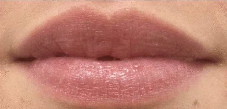 After Image: Restylane Kysse - front