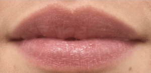 After Image: Restylane Kysse