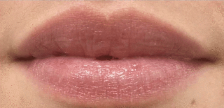 After Image: Restylane Kysse - front