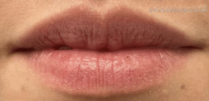 Before Image: Restylane Kysse