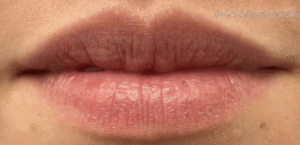 Before Image: Restylane Kysse