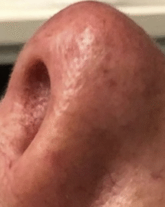 After Image: Sclerotherapy
