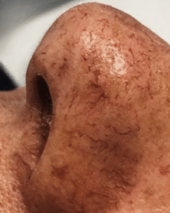 Before Image: Sclerotherapy