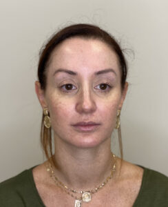 Before Image: Sciton BBL