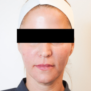 After Image: Sculptra