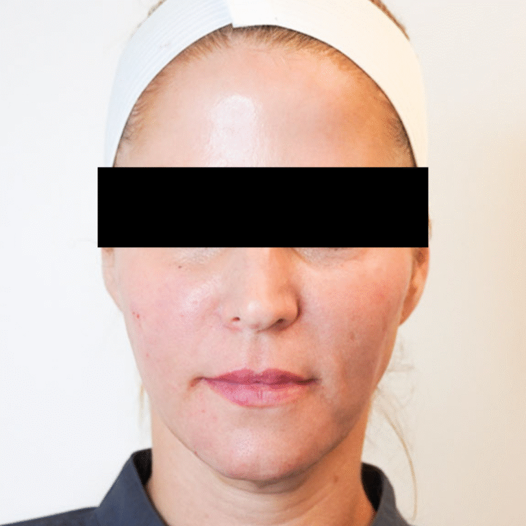 After Image: Sculptra - front