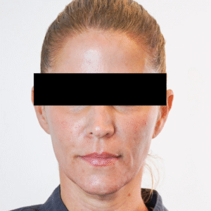 Before Image: Sculptra