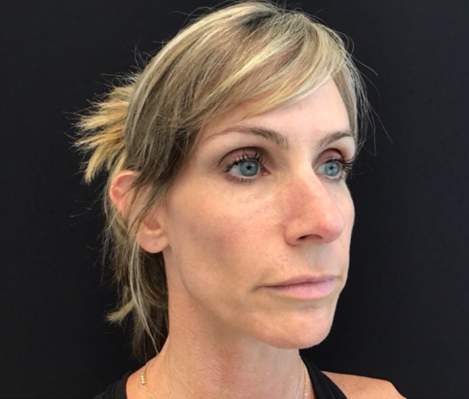After Image: Sculptra - right-front-oblique
