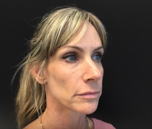 Before Image: Sculptra - right-front-oblique
