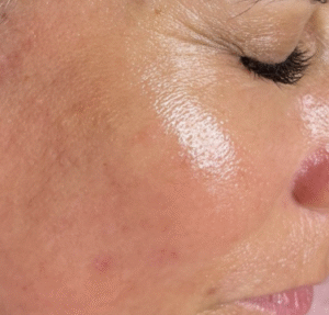 After Image: Microneedling