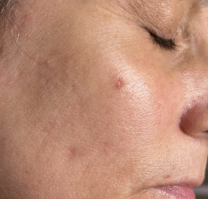 Before Image: Microneedling