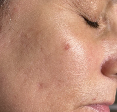 Before Image: Microneedling - right-side