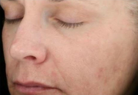 After Image: Chemical Peel - left-front-oblique