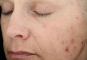 Before Image: Chemical Peel