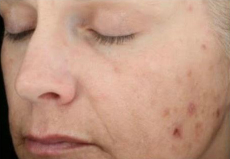 Before Image: Chemical Peel - left-front-oblique