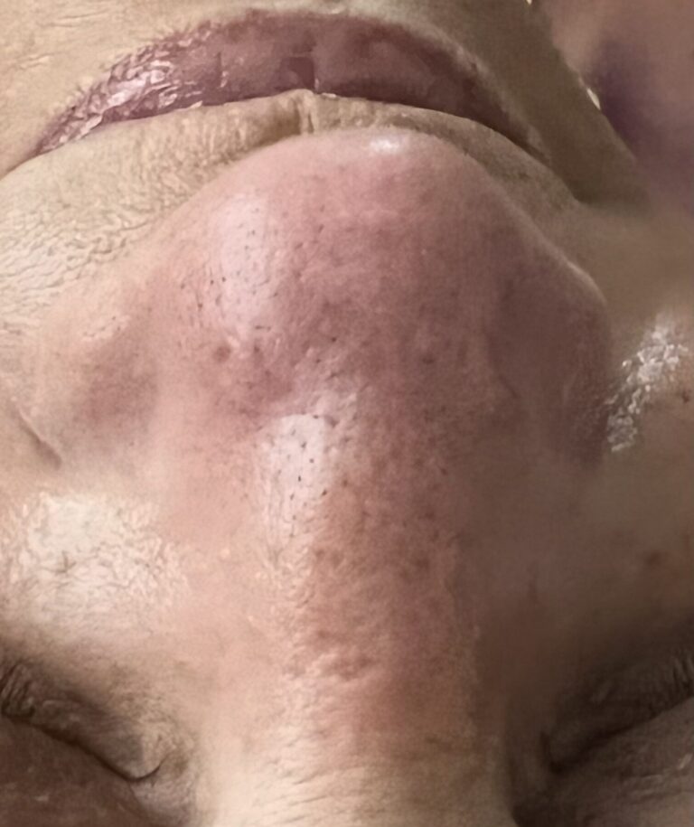 After Image: Extractions – Nose - front
