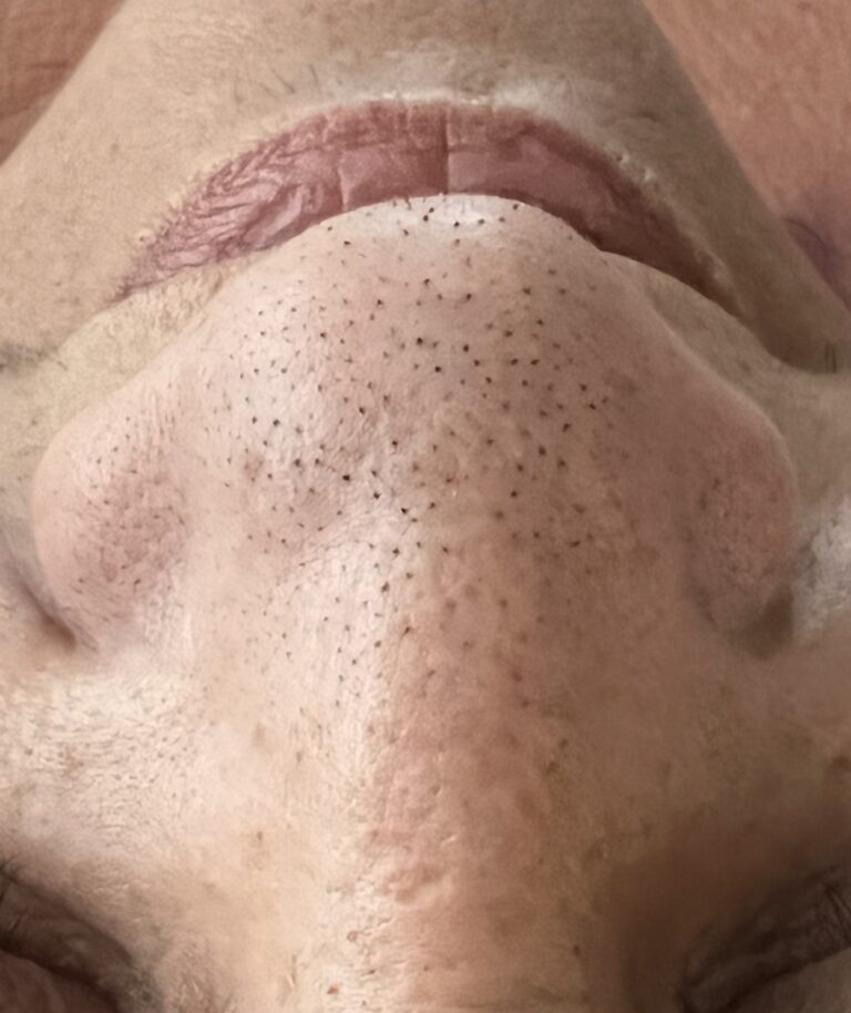 Before Image: Extractions – Nose - front