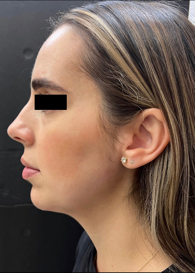 After Image: Chin Filler - left-side