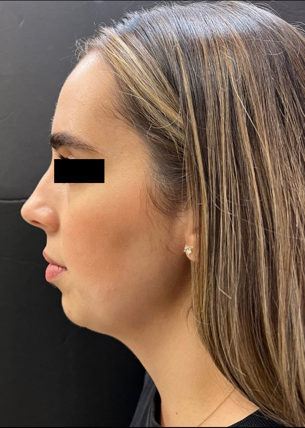 Before Image: Chin Filler - left-side