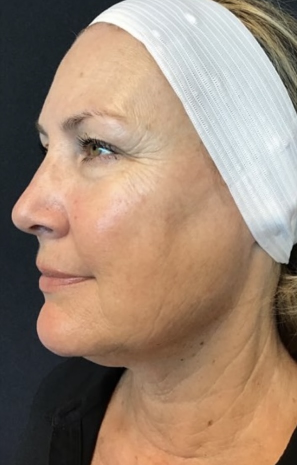 After Image: Halo Laser for Sun Spots - left-front-oblique