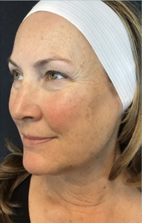 Before Image: Halo Laser for Sun Spots - left-front-oblique