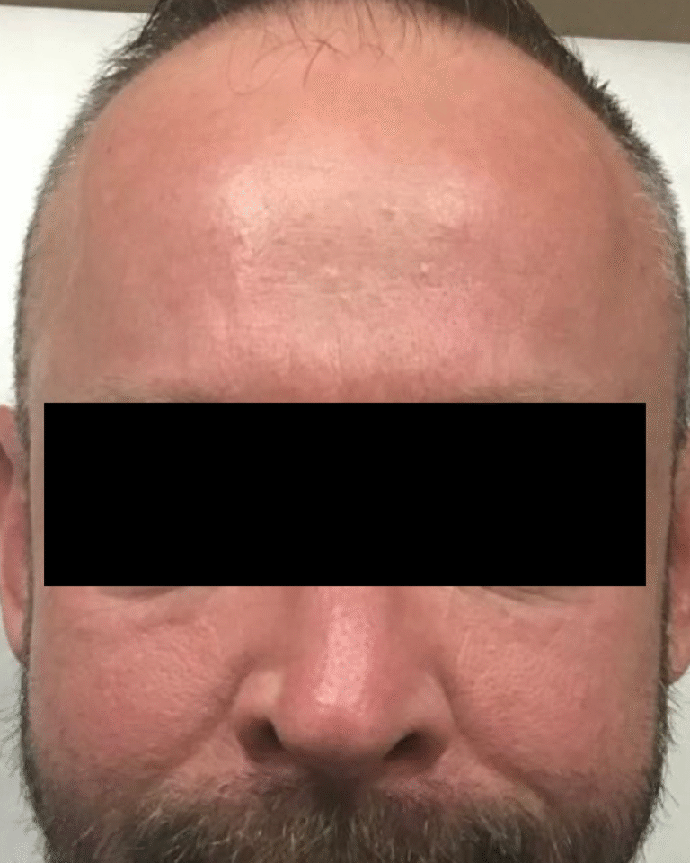 After Image: Botox – Men’s Forehead - front