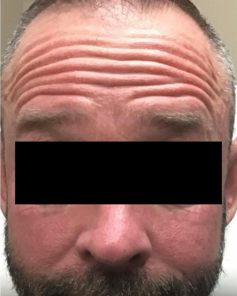 Before Image: Botox – Men’s Forehead - front